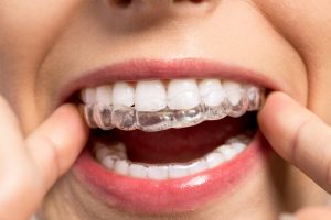 Tips for Cleaning Your Invisalign Aligners