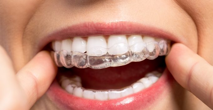 Tips for Cleaning Your Invisalign Aligners