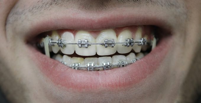 Cleaning Your Braces and Teeth Properly